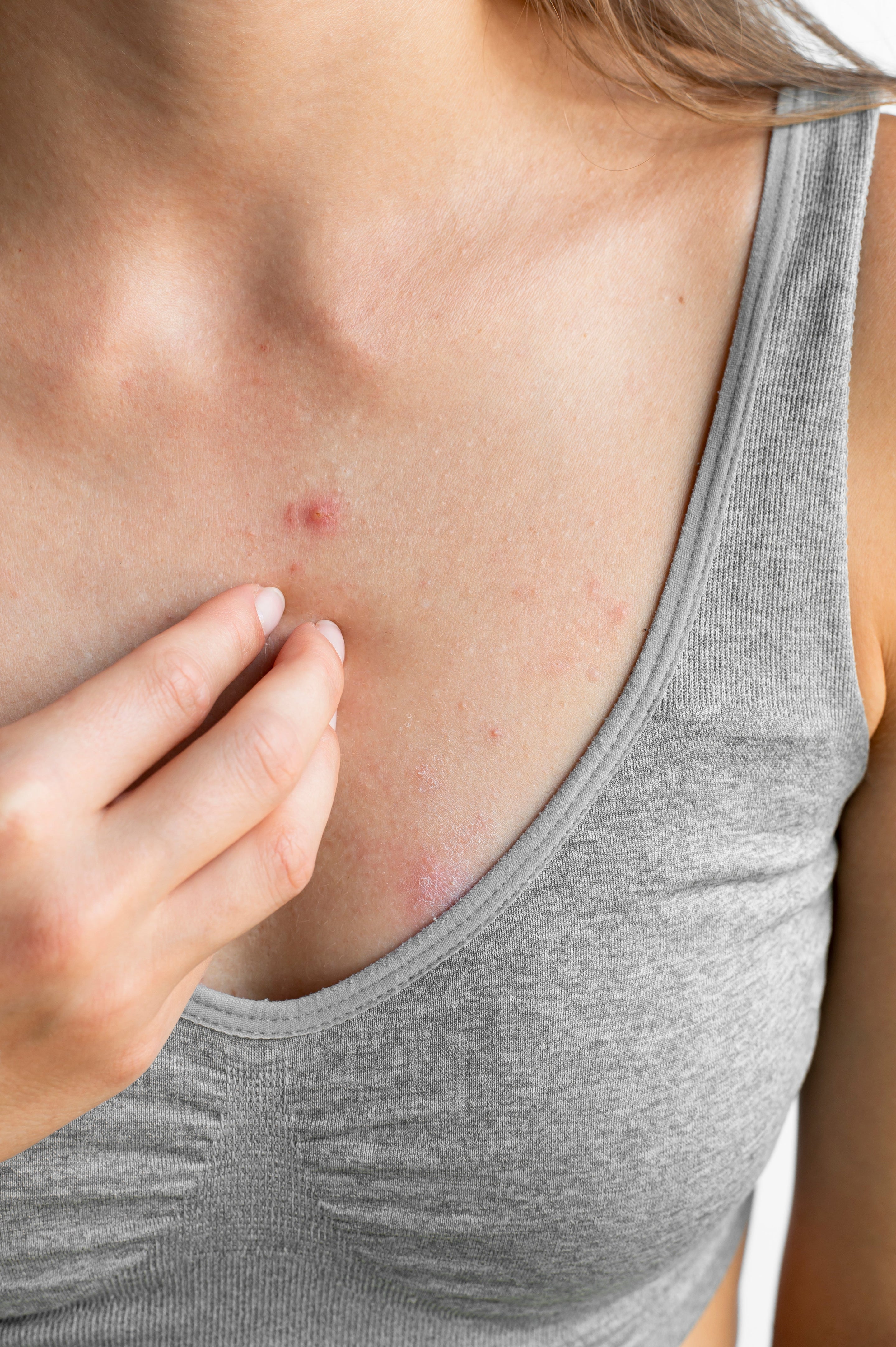 Peau qui gratte, plaques rouges, squames visibles… Vivre avec une peau atopique 